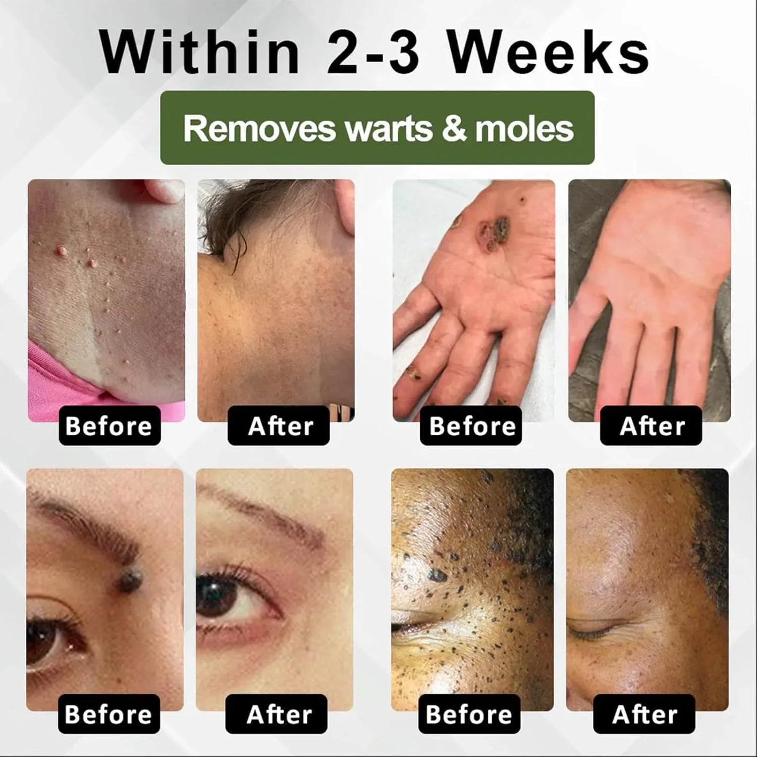 Natureerase Instant Mole Spot Removal Gel 45g hydrating treatment tube