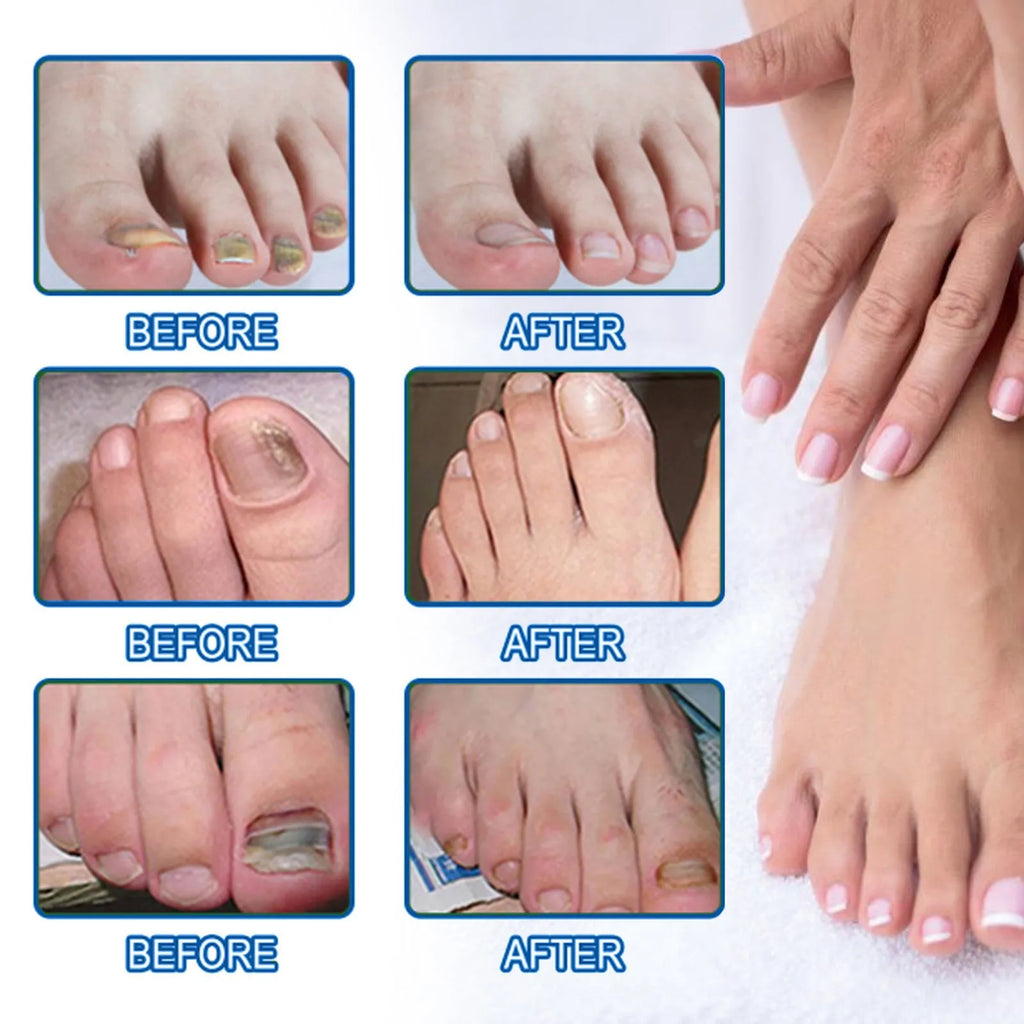 Box of 32 nail repair adhesive bandages, each patch 6.1 by 3.5 cm