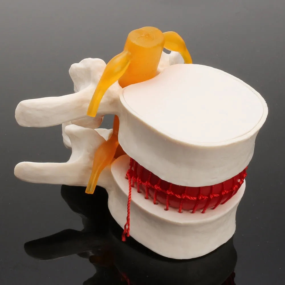 White PVC lumbar spine model demonstrating herniated disc pathology for medical education