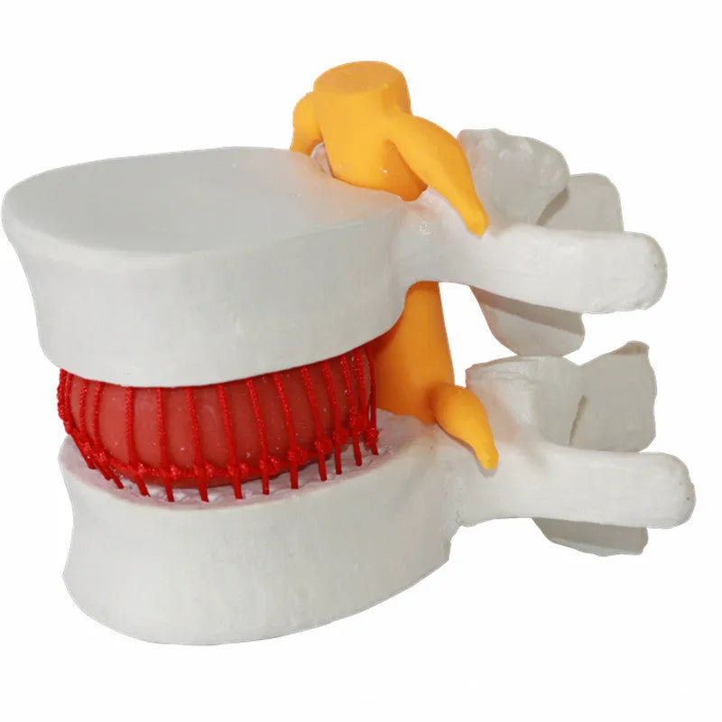 White PVC lumbar spine model demonstrating herniated disc pathology for medical education