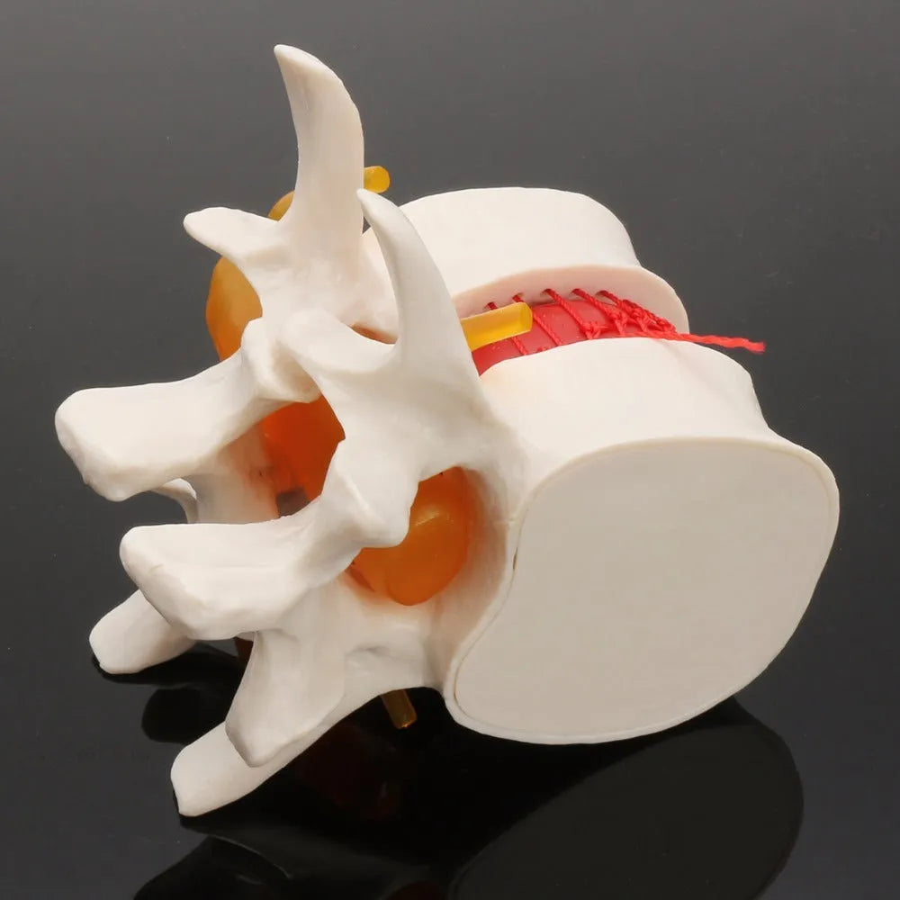 White PVC lumbar spine model demonstrating herniated disc pathology for medical education