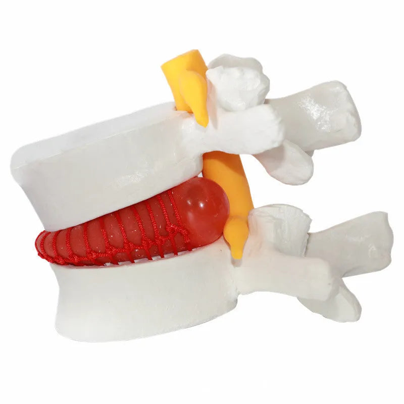 White PVC lumbar spine model demonstrating herniated disc pathology for medical education
