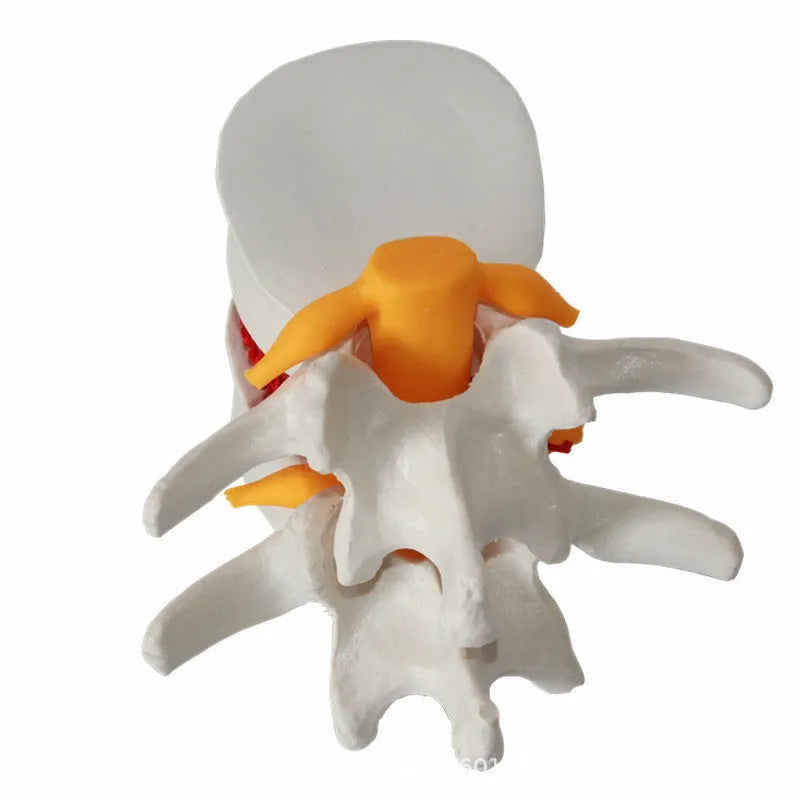 White PVC lumbar spine model demonstrating herniated disc pathology for medical education