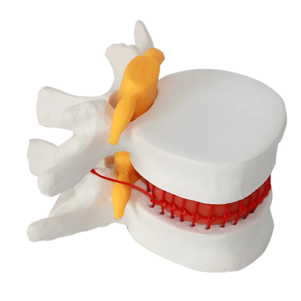 White PVC lumbar spine model demonstrating herniated disc pathology for medical education
