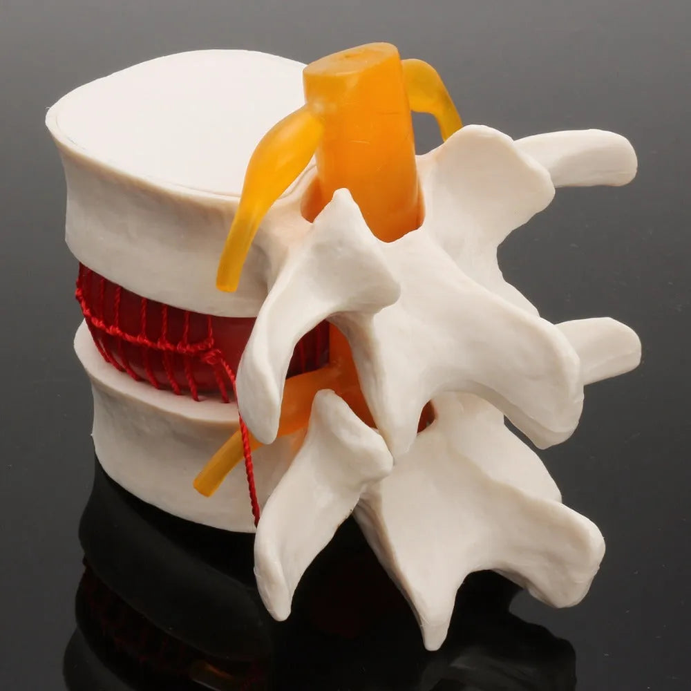White PVC lumbar spine model demonstrating herniated disc pathology for medical education