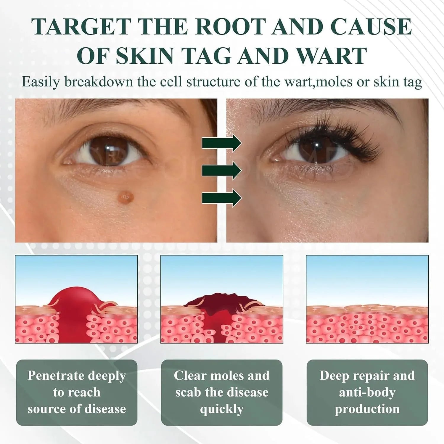 Natureerase Instant Mole Spot Removal Gel 45g hydrating treatment tube