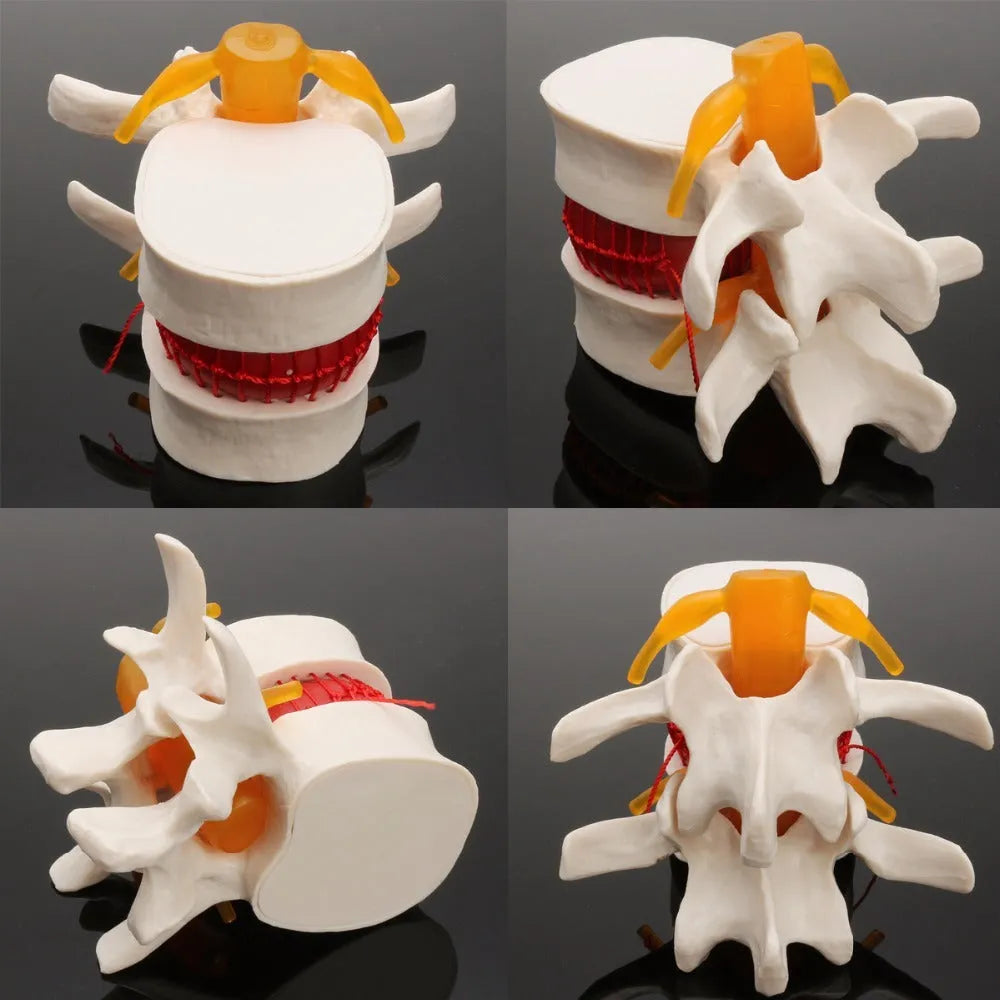 White PVC lumbar spine model demonstrating herniated disc pathology for medical education